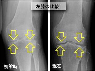 左膝のレントゲン画像の比較