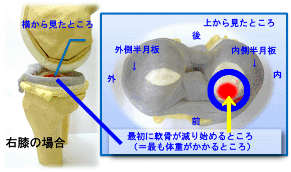 最初に軟骨が減り始めるところ
