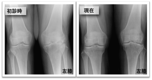 初診時と現在(治療)のレントゲン画像の比較