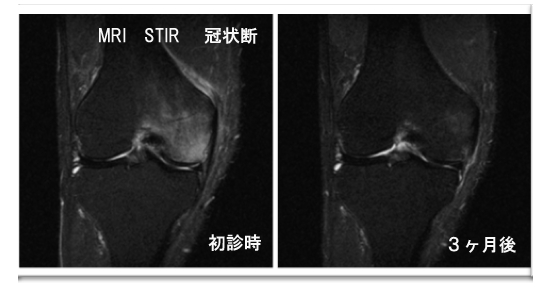 骨壊死・骨挫傷MRI 初回と3ヶ月後の比較