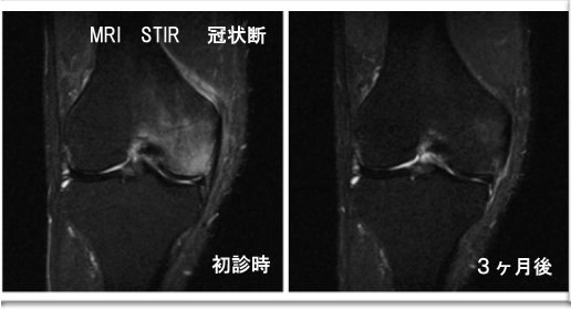 骨壊死・骨挫傷MRI初回と３ヶ月後の比較