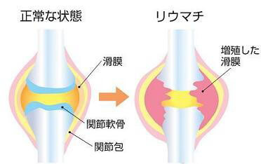 関節内で起こっている関節リウマチの仕組み