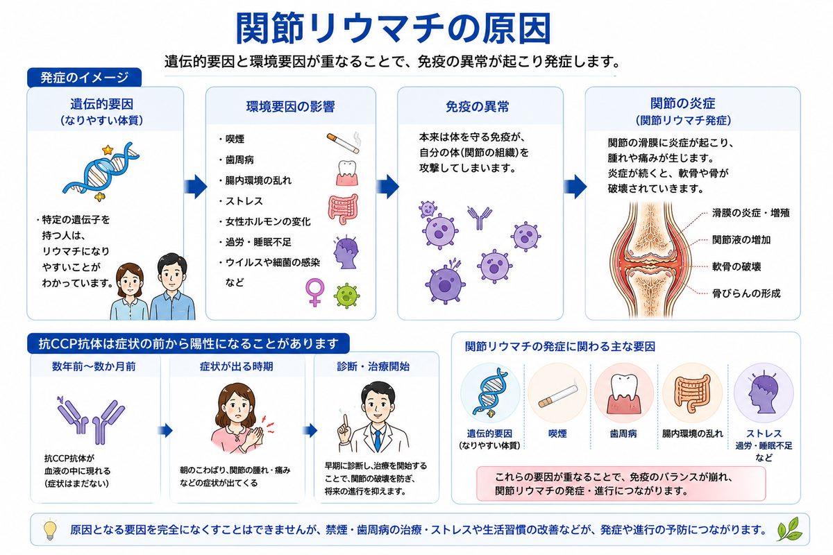 関節リウマチの原因：遺伝的要因と環境要因が重なり免疫の異常が起こる流れを示した図解