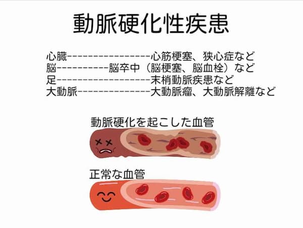 リウマチと動脈硬化性疾患