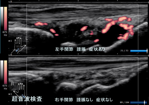 関節超音波検査（US）のリウマチ（RA）所見