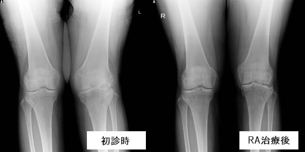 リウマチ初診時と治療後の膝関節レントゲン画像の比較
