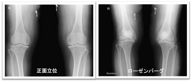 変形性膝関節症所見