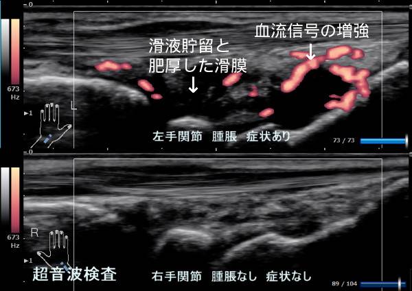 関節リウマチの超音波（エコー）検査のポイント