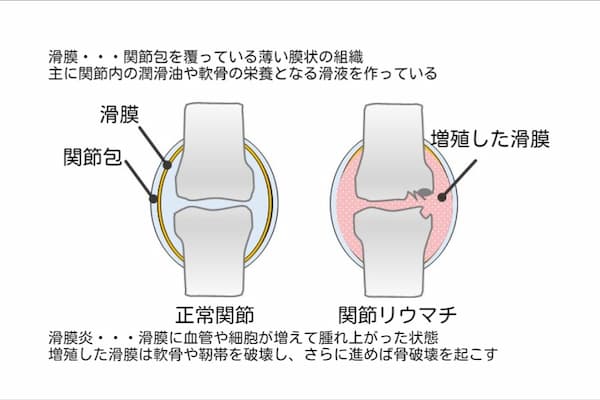 関節リウマチ　滑膜炎について